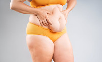 Tummy Tuck Surgery in Delhi